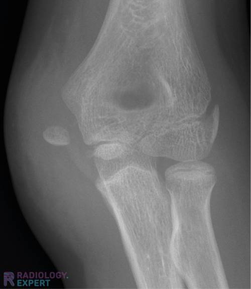 x-elbow